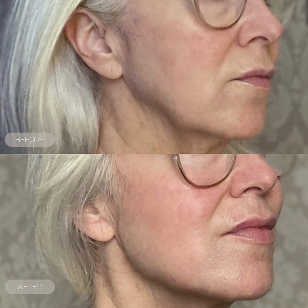 Before and after comparison of a woman's face with visible aging signs.