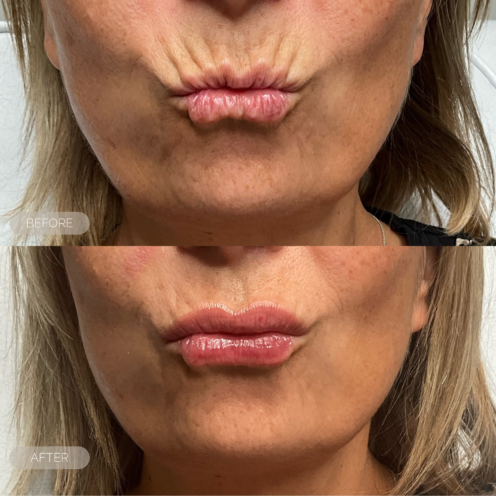 Before and after comparison of a woman's lips with visible skin texture differences.