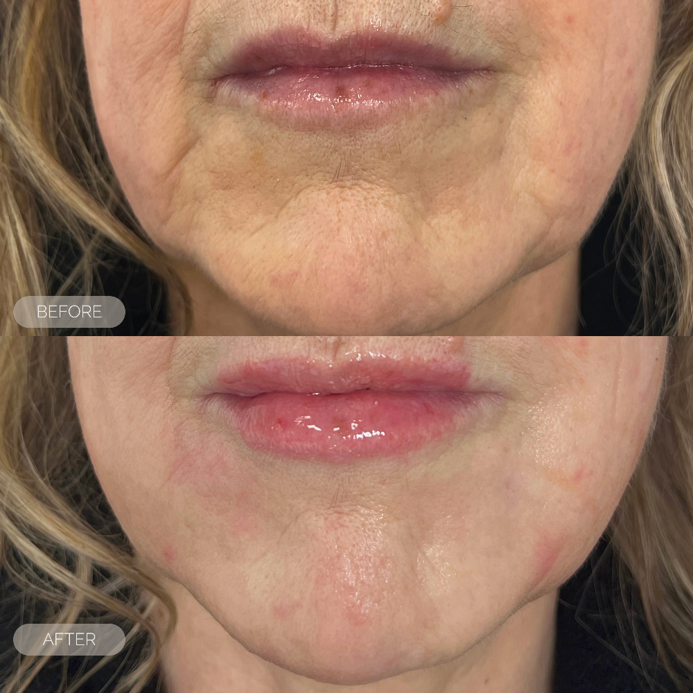 Before and after comparison of a person's lips with visible aging changes. treatment for chin lines