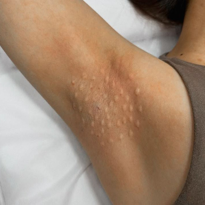 hyperhidrosis dundee scotland