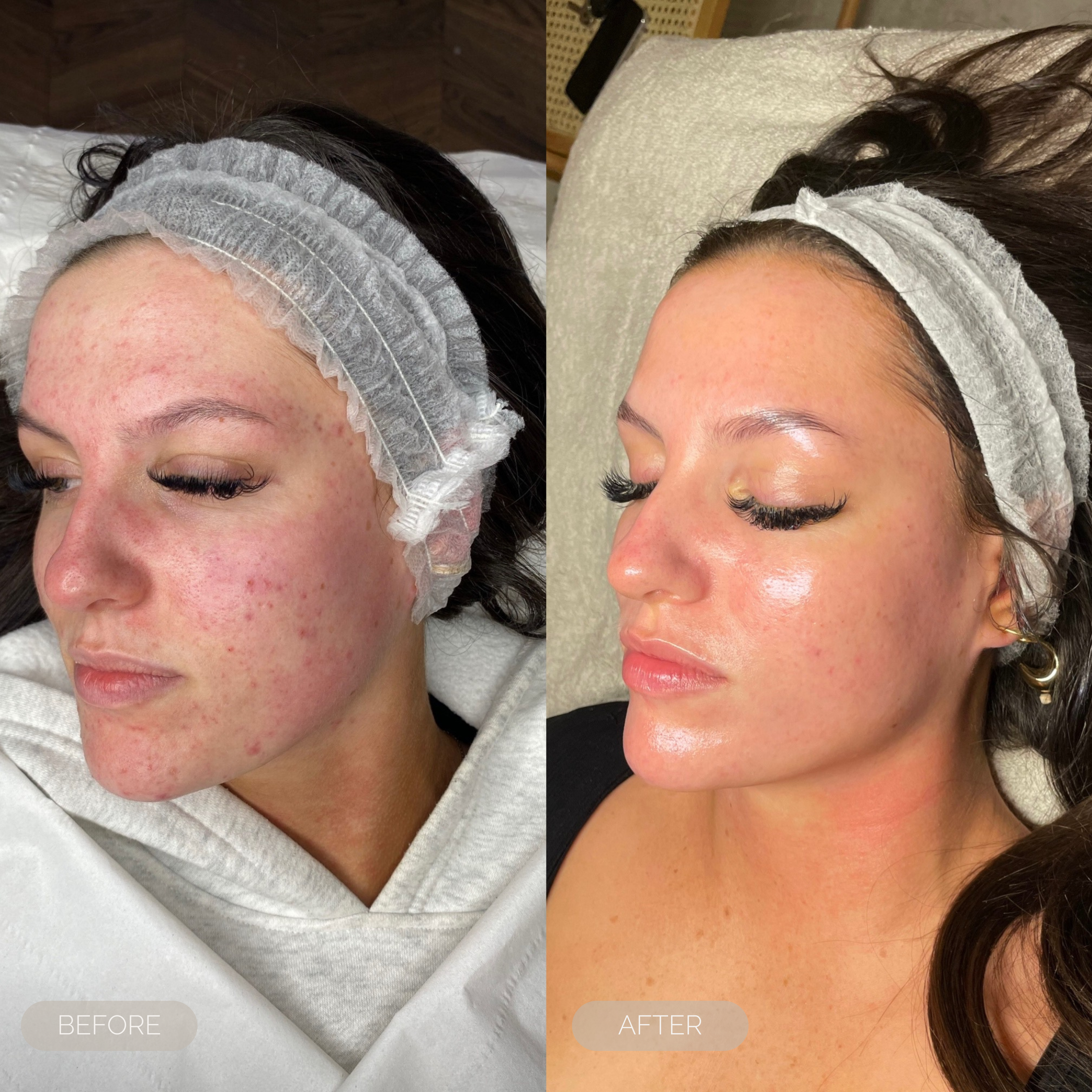 fresh inc medispa acne oily skin treatments dundee scotland 