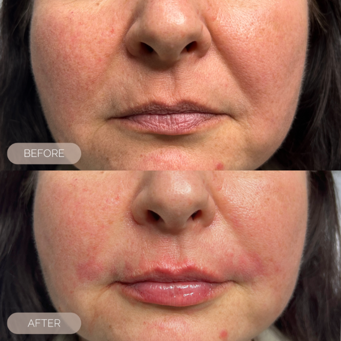 Before and after comparison of a person's face with visible skin nasolabial improvement.