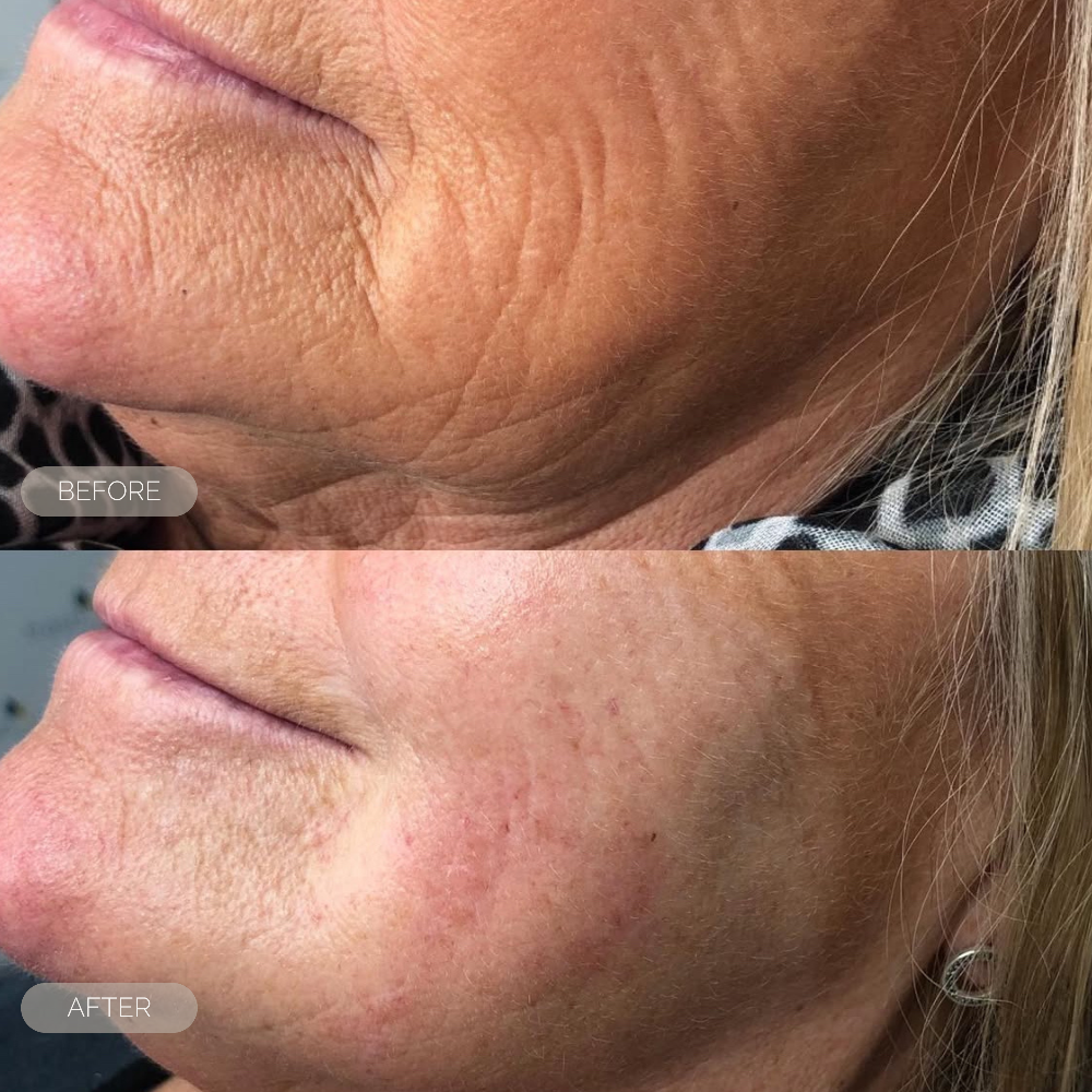 fresh inc medispa shop image dundee scotland dermal filler animation