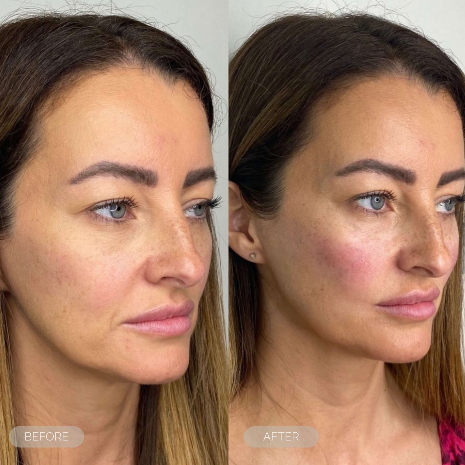 cheeck volumisation injections filler dundee scotland