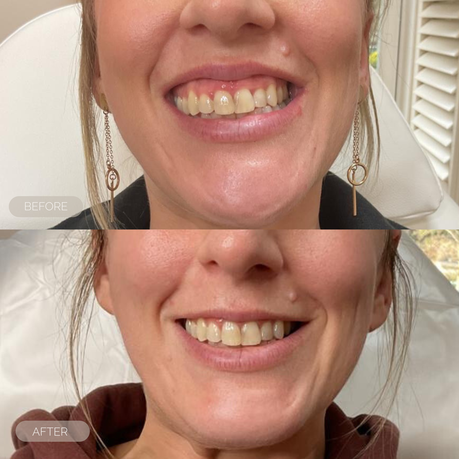 Before and after gum,my smile treatment dundee scotland