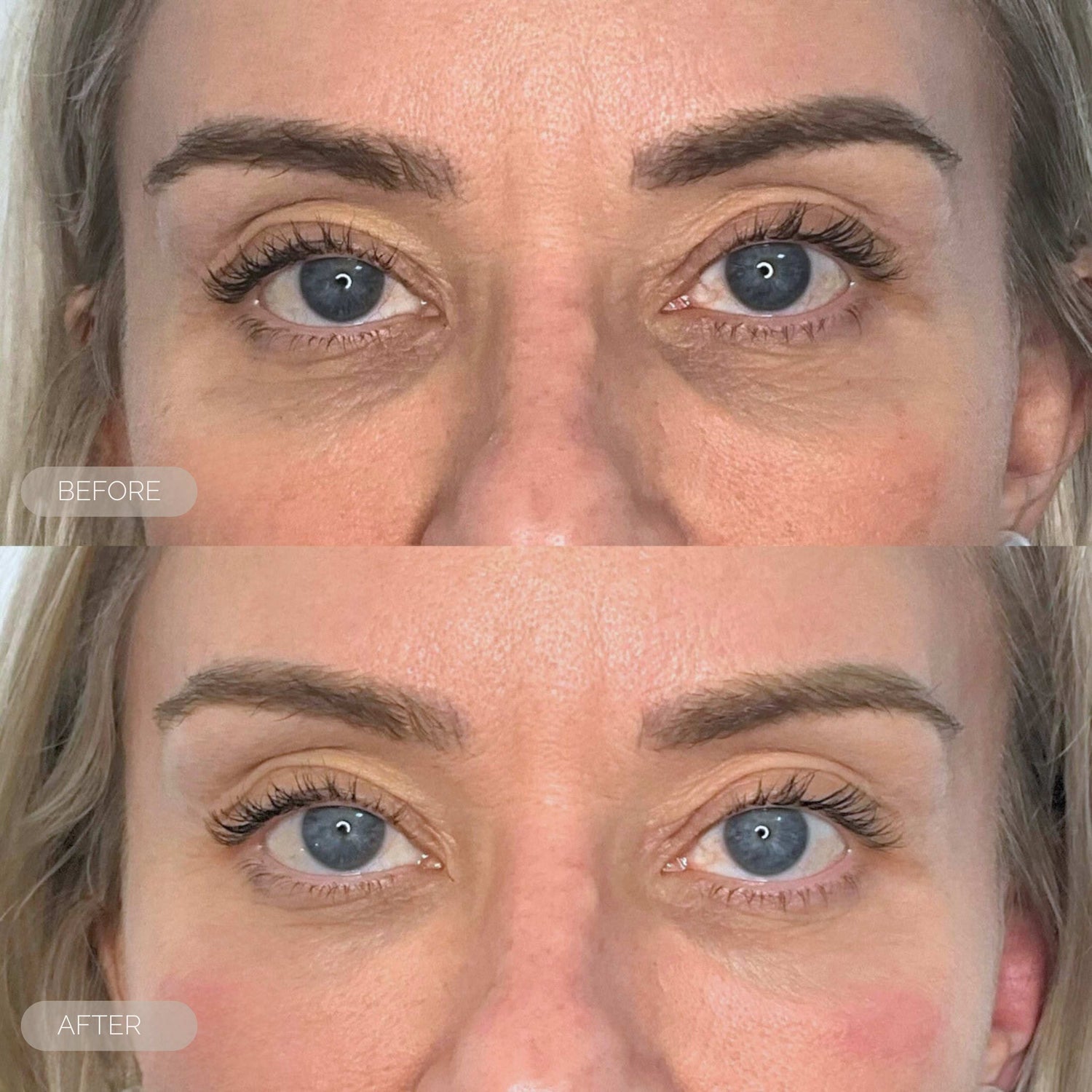 before and after tear trough treament dundee scotland