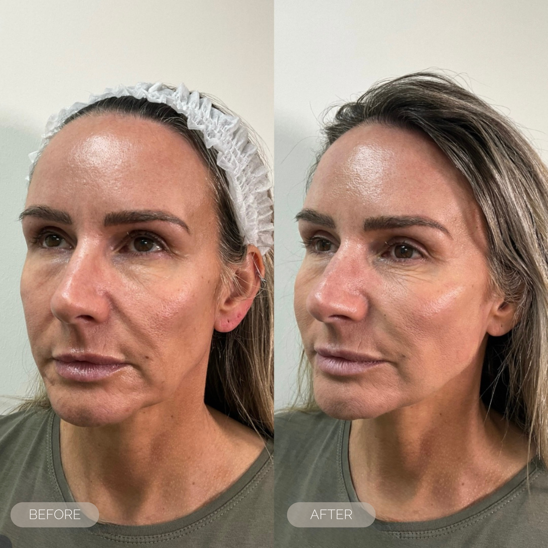 Jowl & Jawline Treatments | Fresh Inc Medispa Dundee, Scotland ...