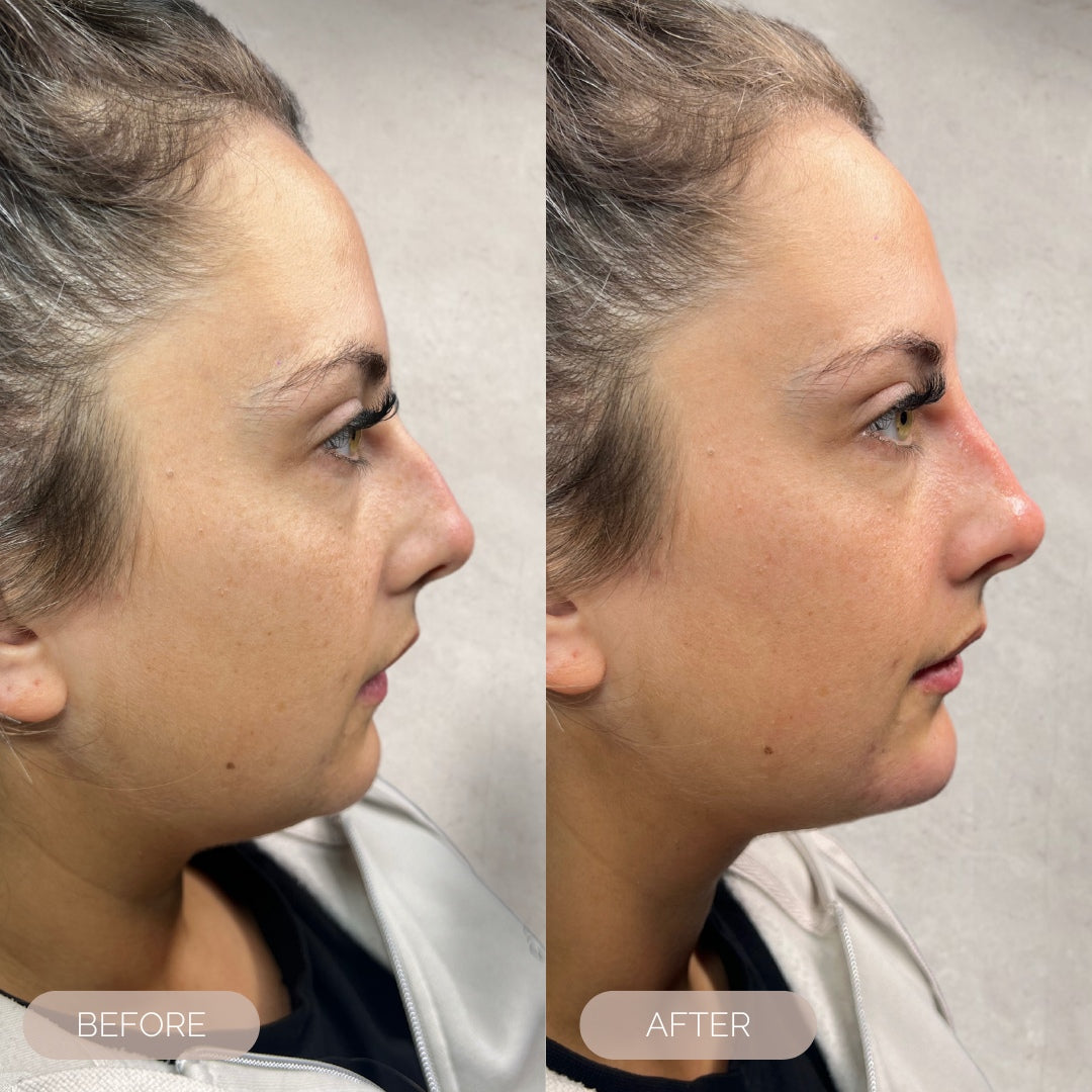 rhinoplasty dundee scotland injections