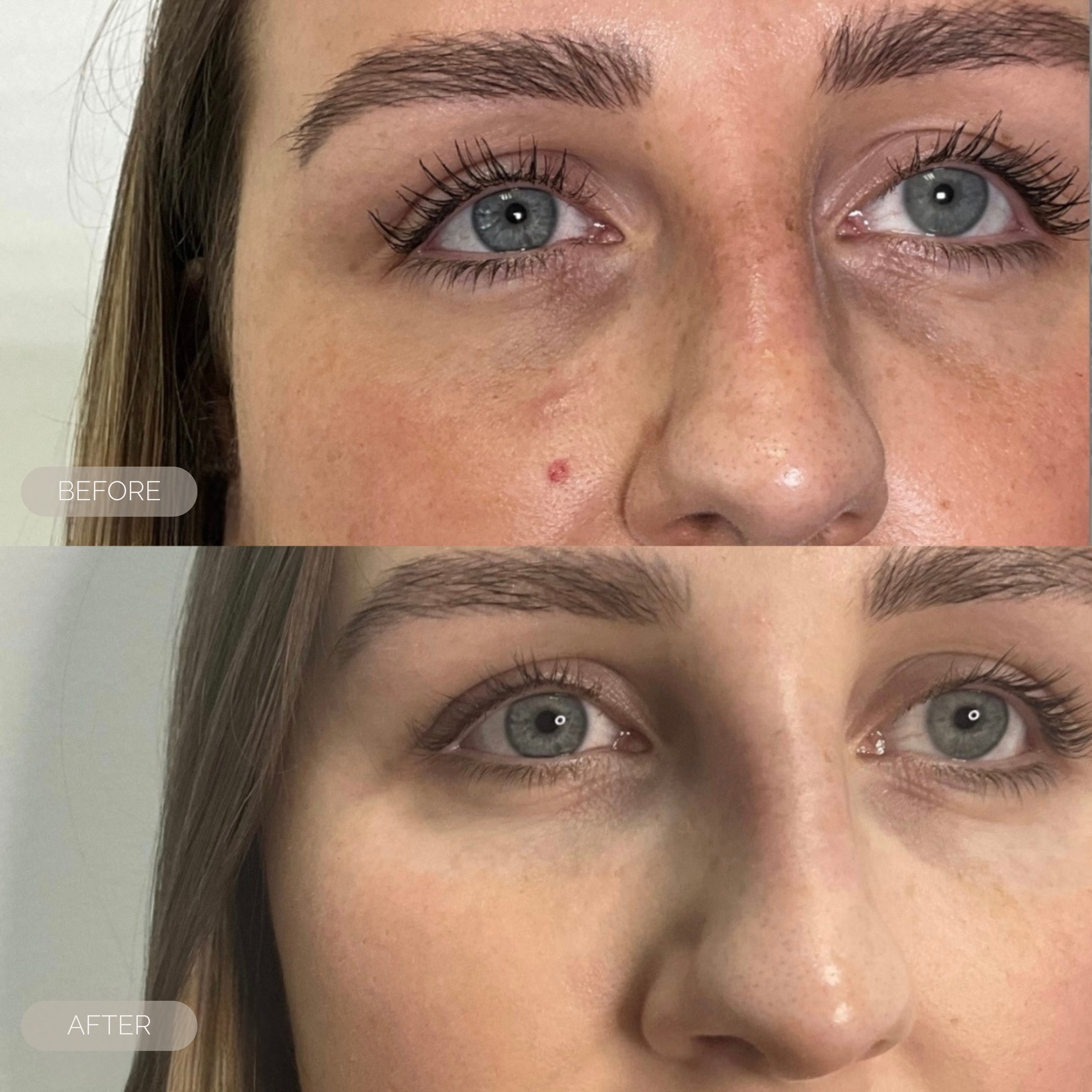 fresh inc medispa skin lesions  dundee scotland 