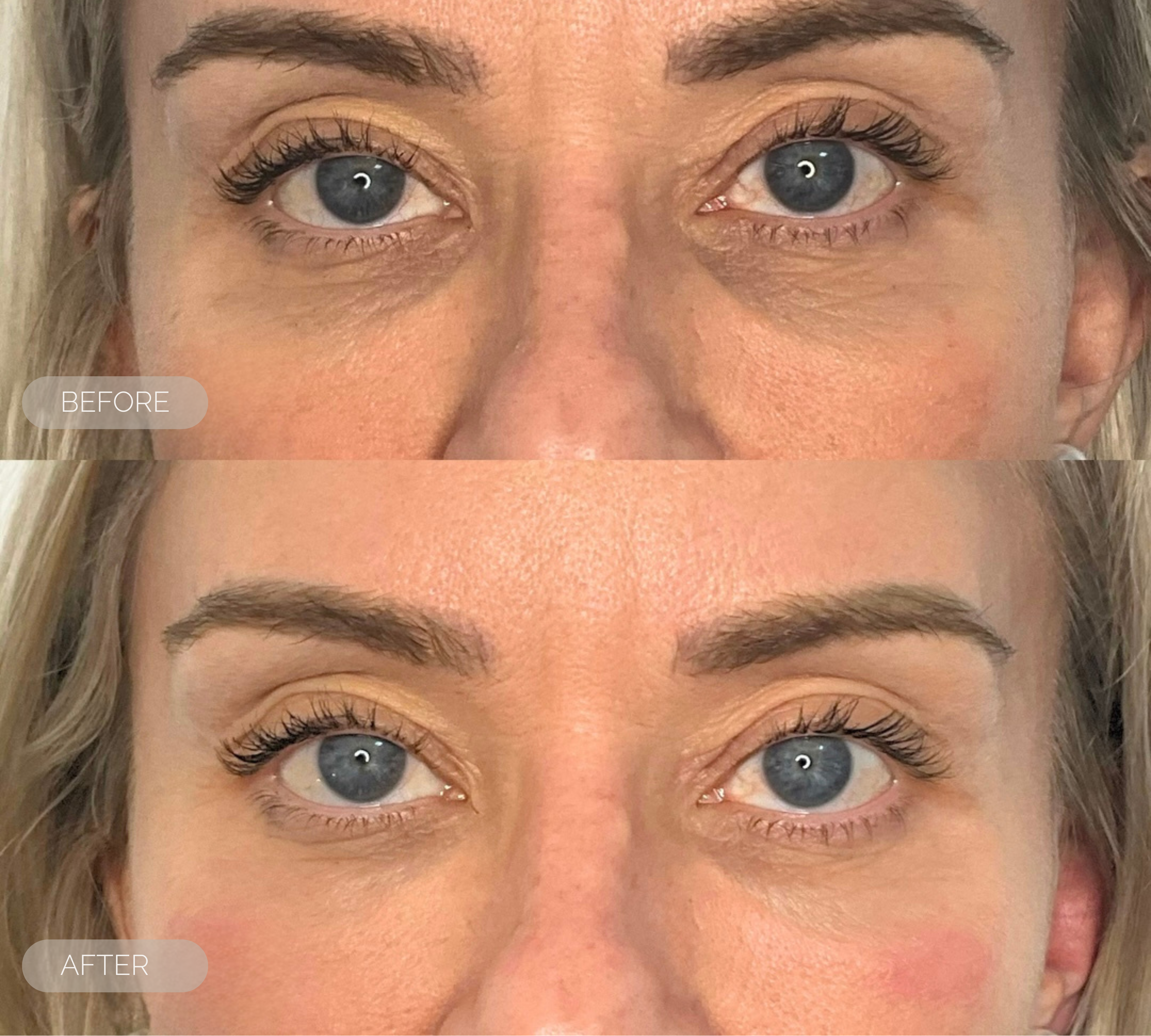 fresh inc medispa tired eyes treatment dundee scotland 